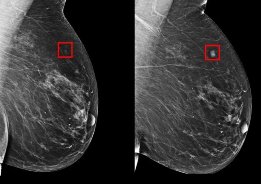 ¿Cómo la IA podría anticipar la aparición del cáncer de mama?