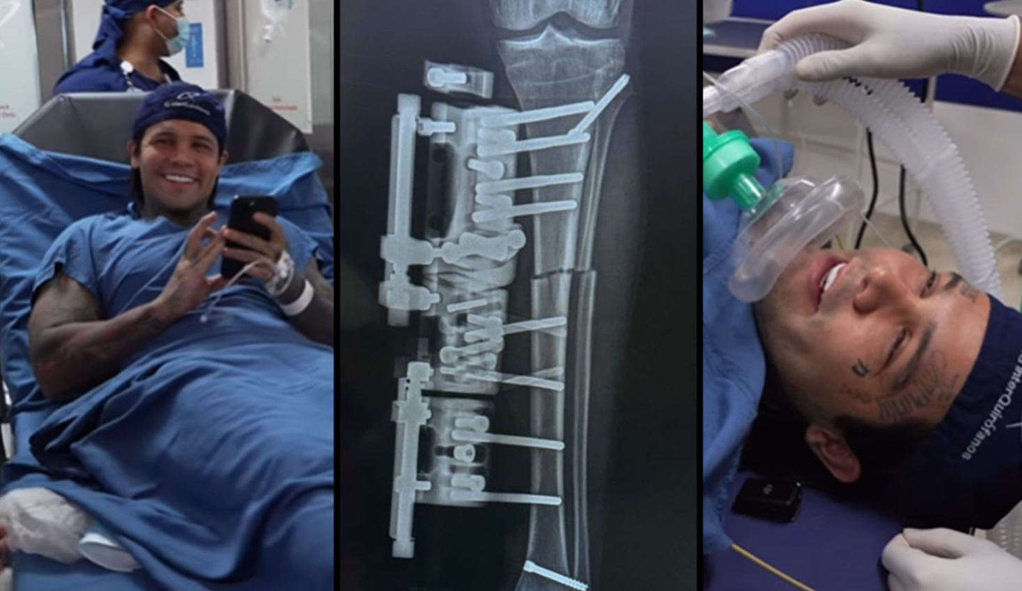 Así es el doloroso procedimiento para alargar piernas al que se sometió Yeferson Cossio