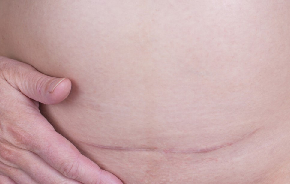 Mujeres con cesáreas previas podrían presentar dificultades para volver a concebir ¿Por qué?