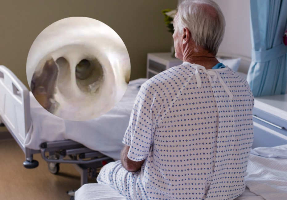 Descubren cinco gusanos parasitarios en paciente durante procedimiento médico