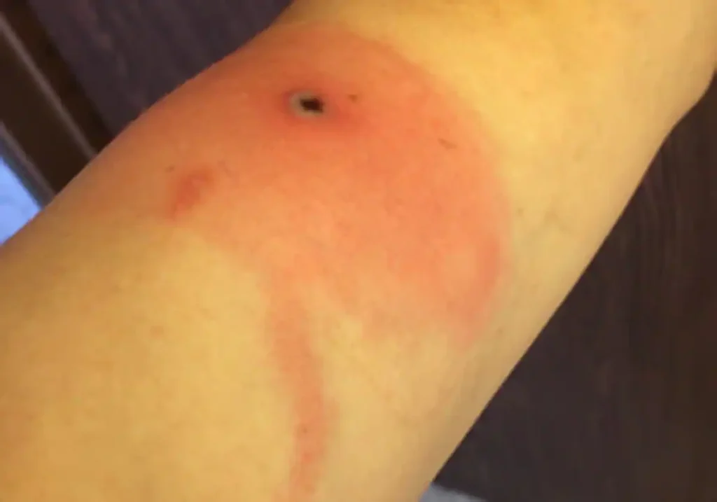 Una lesión de viruela de Alaska de 10 días de evolución Foto: HEALTH ALASKA GOV