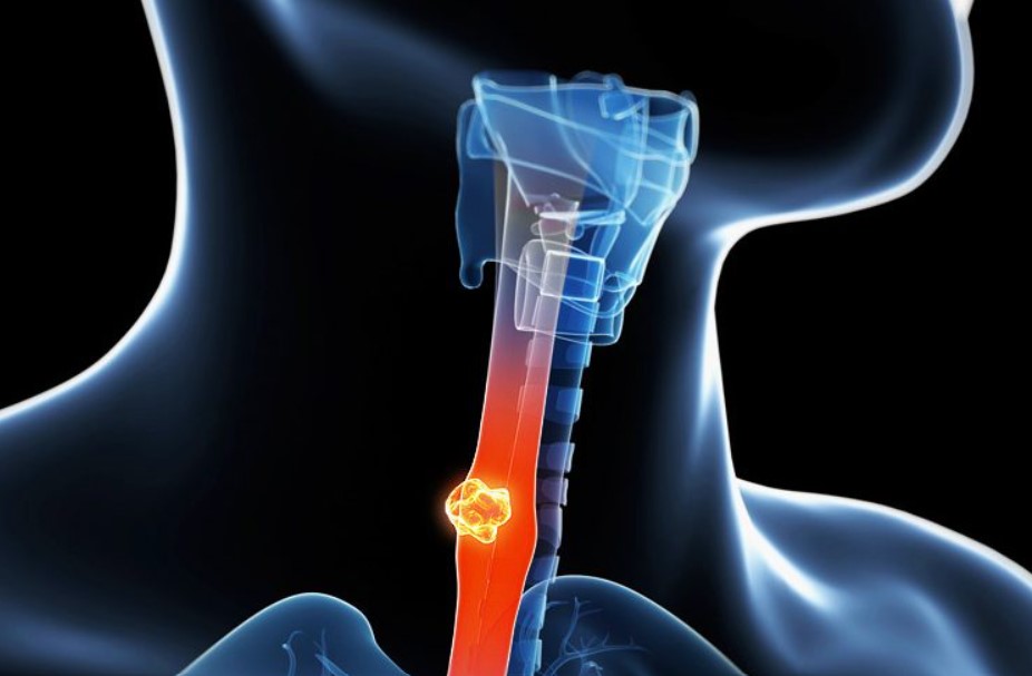 Inteligencia Artificial revoluciona detección temprana del cáncer de esófago