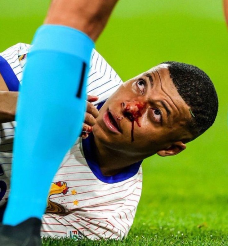 Los memes que surgieron en redes sociales tras la lesión de nariz de Mbappé