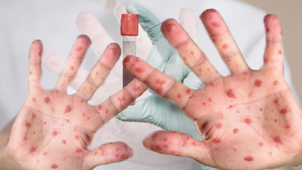 La enfermedad puede presentarse con dos fases diferenciadas Foto: archivo RCN