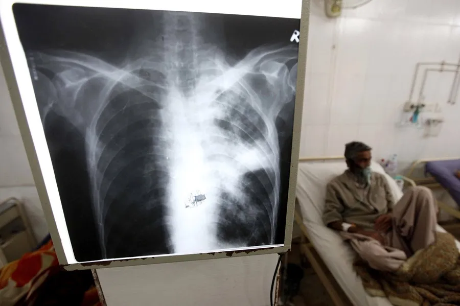 Un paciente con tuberculosis en un hospital de Peshawar, Pakistán. EFE/Arshad Arbab/Archivo
