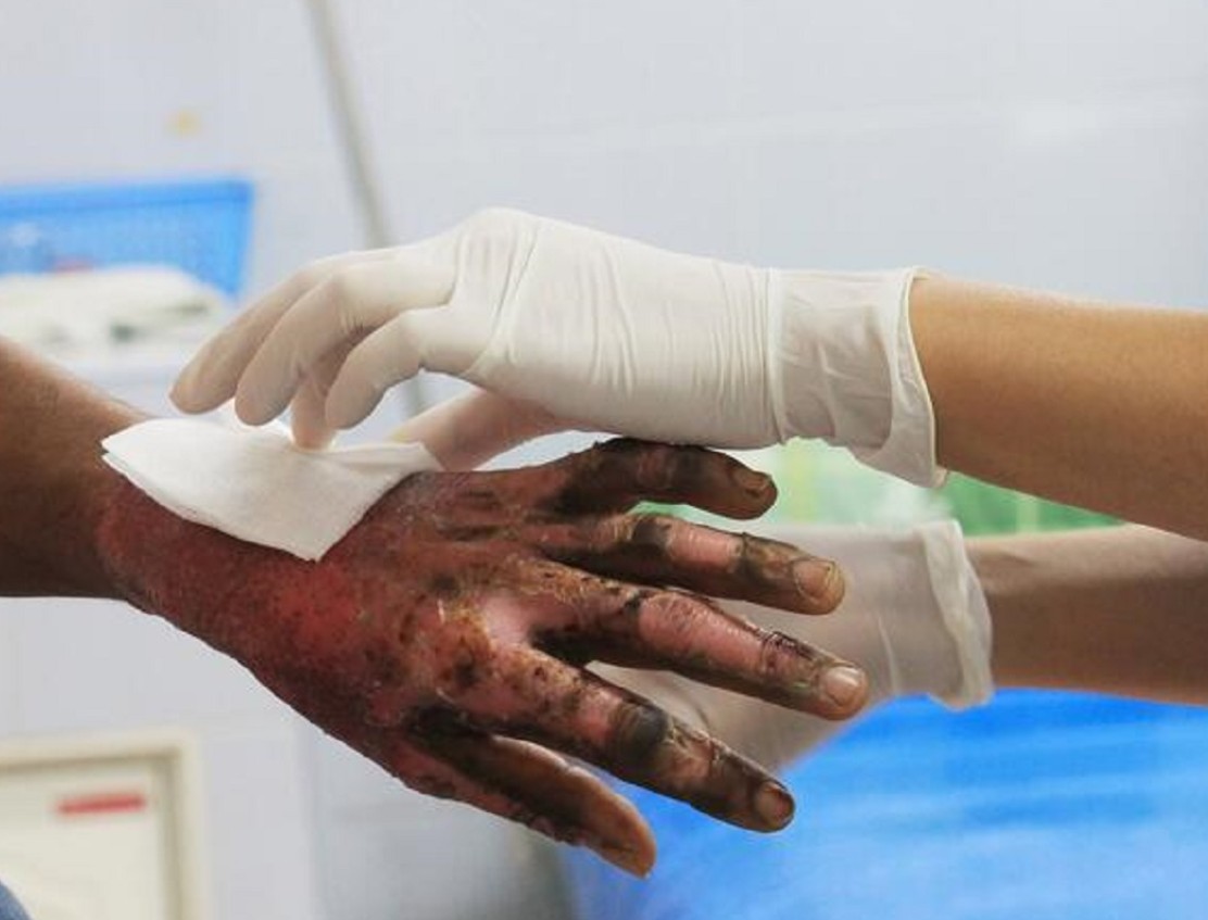 Temporada navideña 2024-2025 dejó más de mil quemados por pólvora en toda Colombia