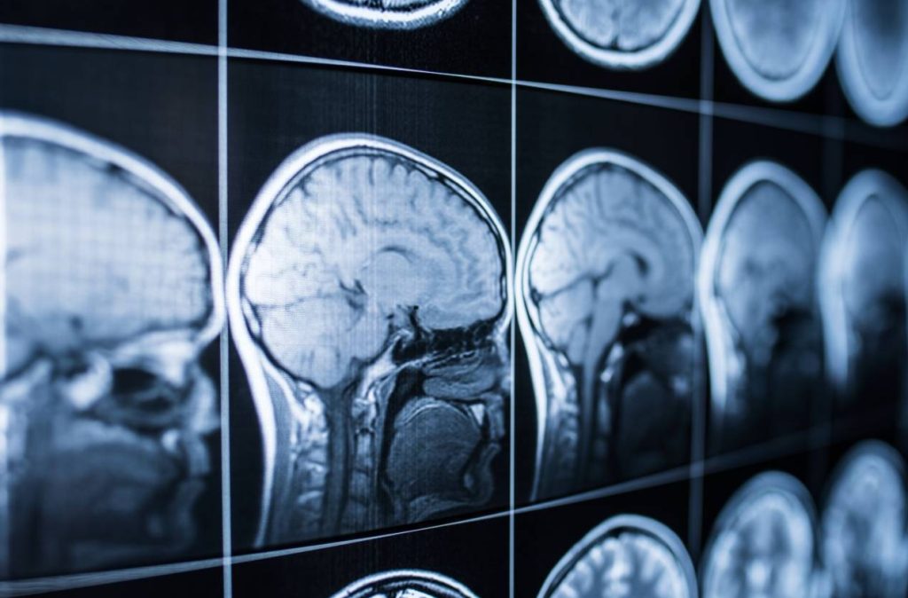 Científicos desarrollan un fármaco experimental que podría transformar el tratamiento del cáncer cerebral