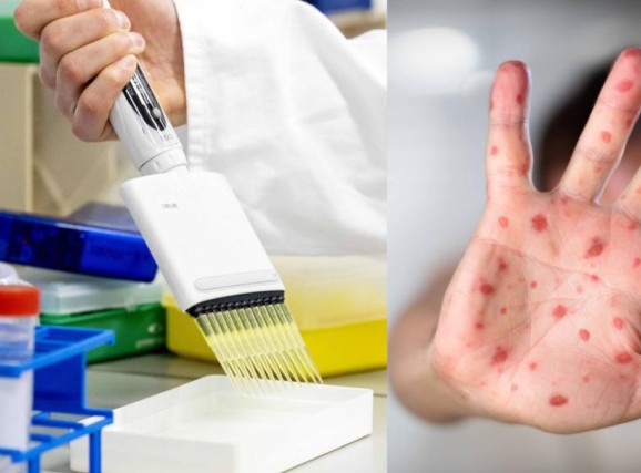 Un hombre de 37 años, residente en Barrancabermeja, se convirtió en el primer caso confirmado de viruela símica